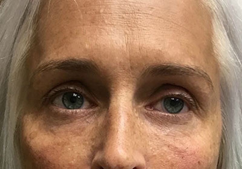 Face Before & After Gallery - Patient 63360264 - Image 4