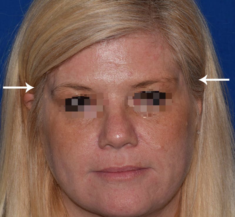 Face Before & After Gallery - Patient 63360265 - Image 1
