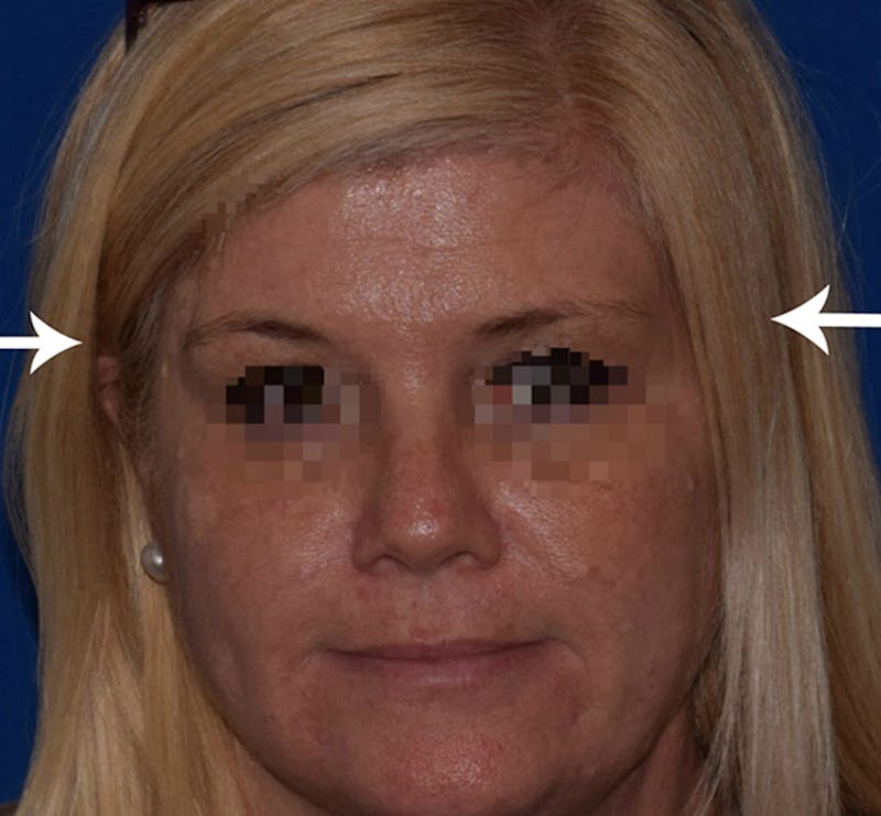 Cosmetic Surgical Before & After Gallery - Patient 63360265 - Image 2