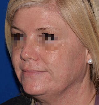 Face Before & After Gallery - Patient 63360265 - Image 4