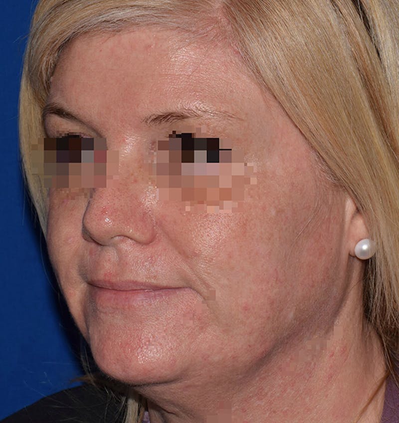 Cosmetic Surgical Before & After Gallery - Patient 63360265 - Image 4