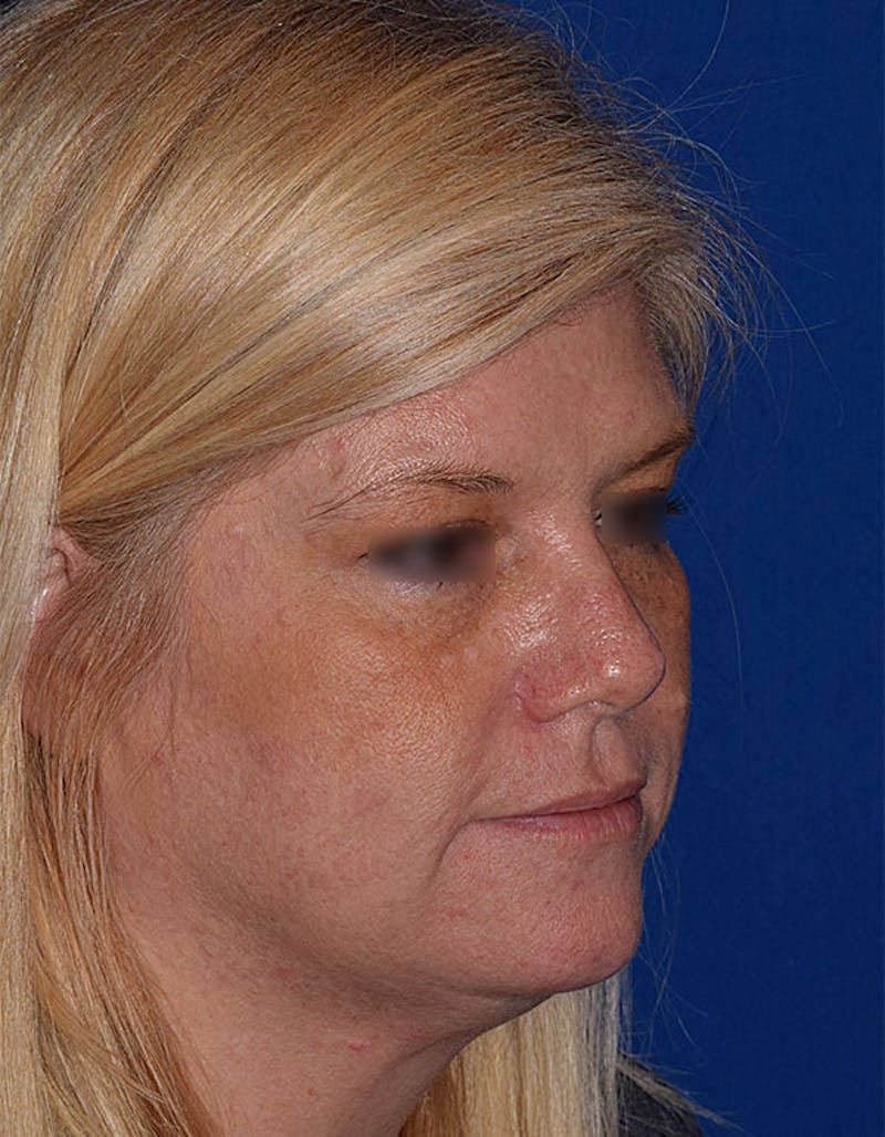 Cosmetic Surgical Before & After Gallery - Patient 63360265 - Image 5
