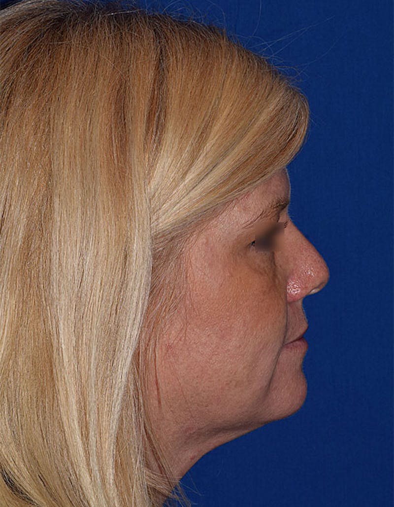 Face Before & After Gallery - Patient 63360265 - Image 7