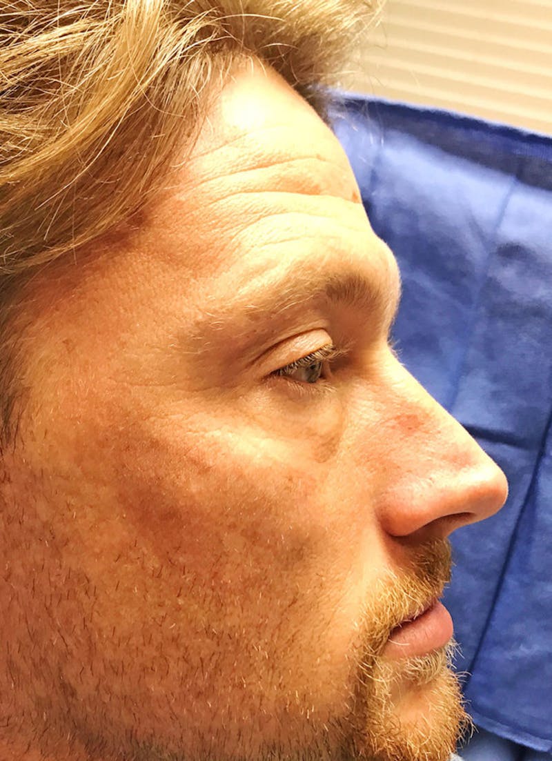 Face Before & After Gallery - Patient 63360267 - Image 1