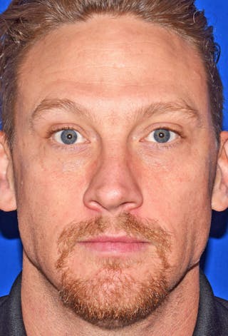 Face Before & After Gallery - Patient 63360267 - Image 4