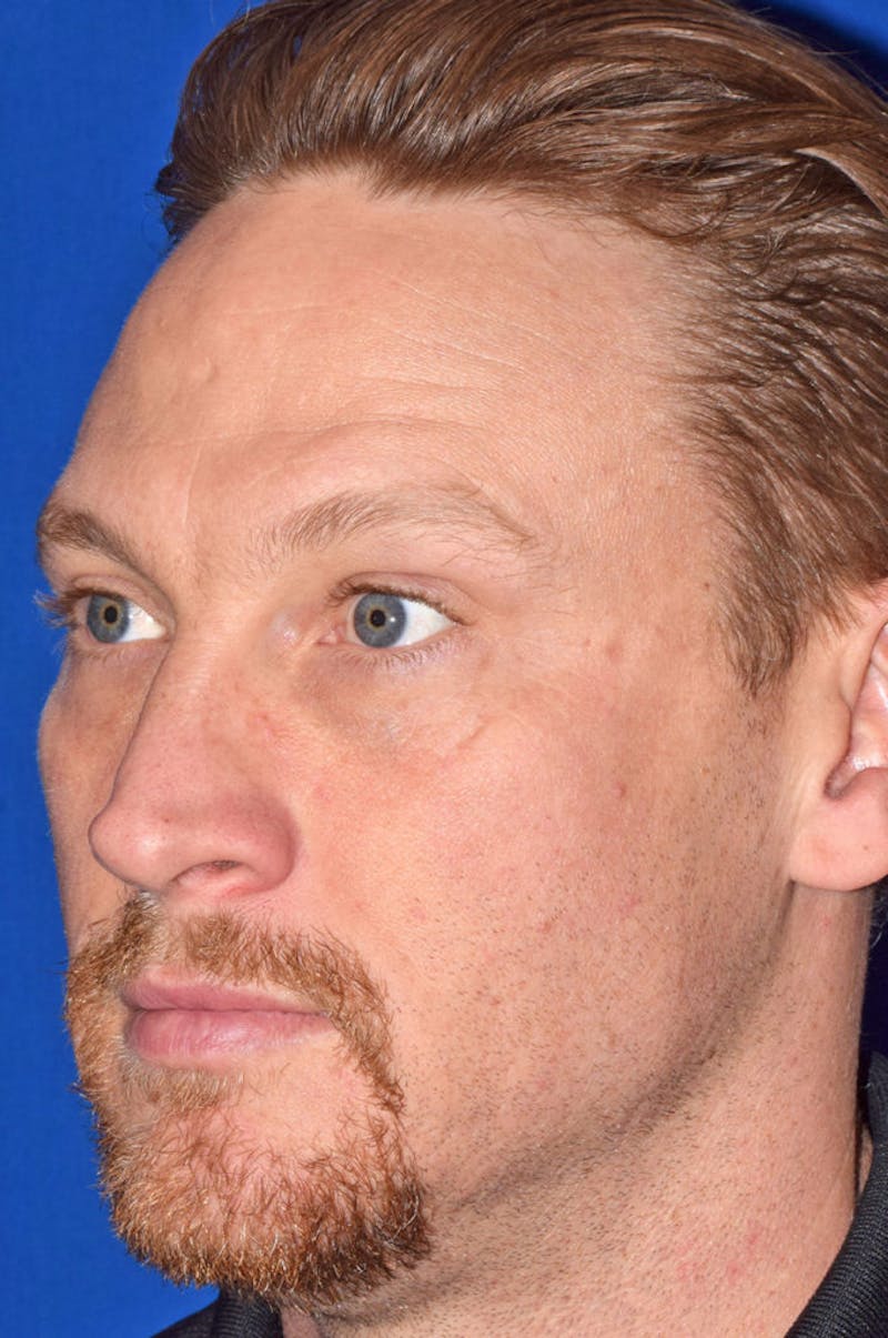 Face Before & After Gallery - Patient 63360267 - Image 6