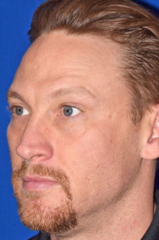 Face Before & After Gallery - Patient 63360267 - Image 6