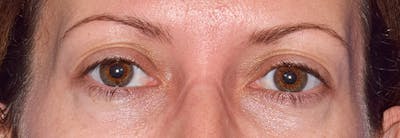 Face Before & After Gallery - Patient 63360268 - Image 2