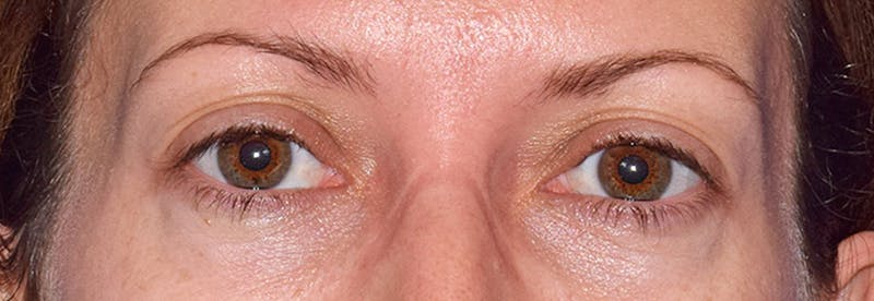 Face Before & After Gallery - Patient 63360268 - Image 2