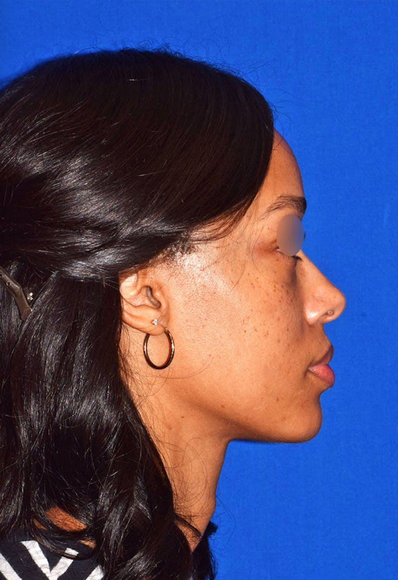 Face Before & After Gallery - Patient 63360270 - Image 4
