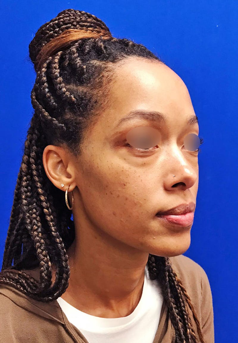 Face Before & After Gallery - Patient 63360270 - Image 5