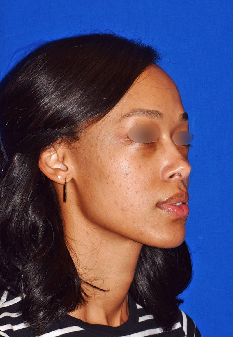 Face Before & After Gallery - Patient 63360270 - Image 6
