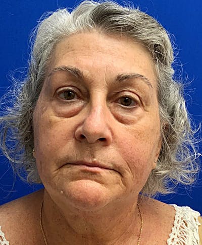 Face Before & After Gallery - Patient 63360275 - Image 1