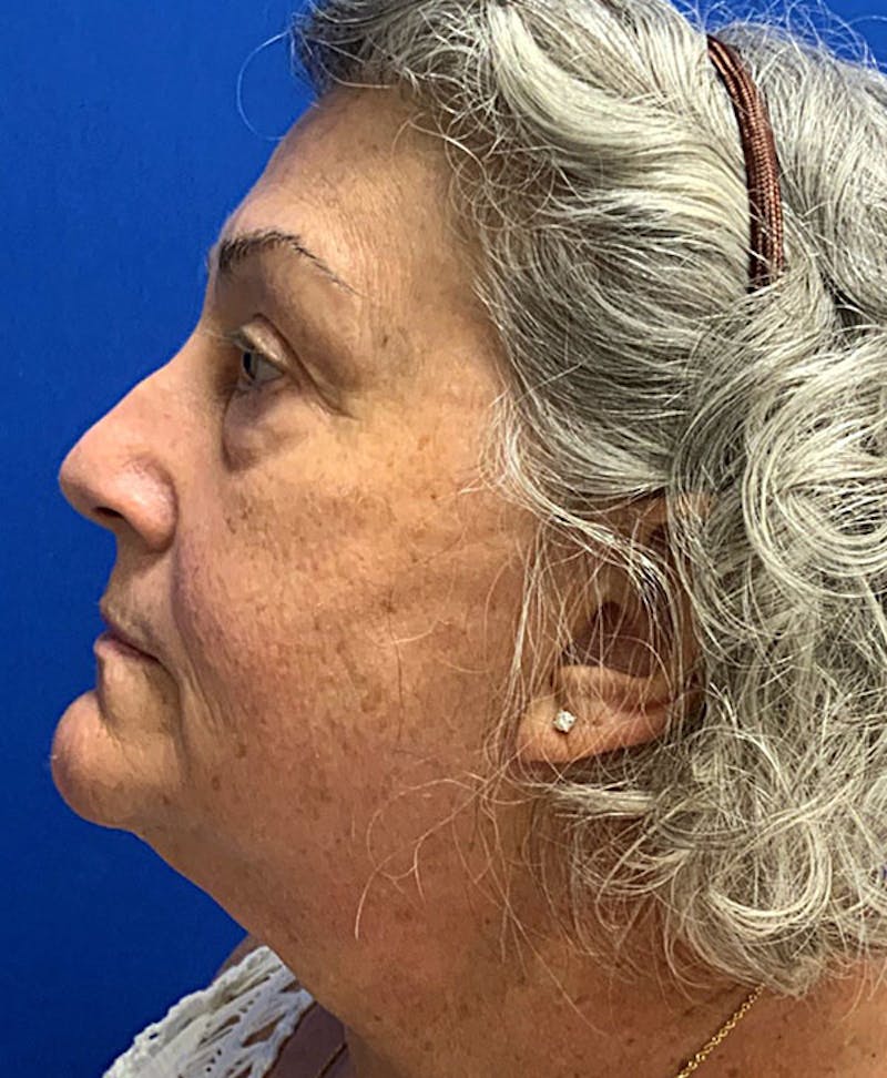 Face Before & After Gallery - Patient 63360275 - Image 5