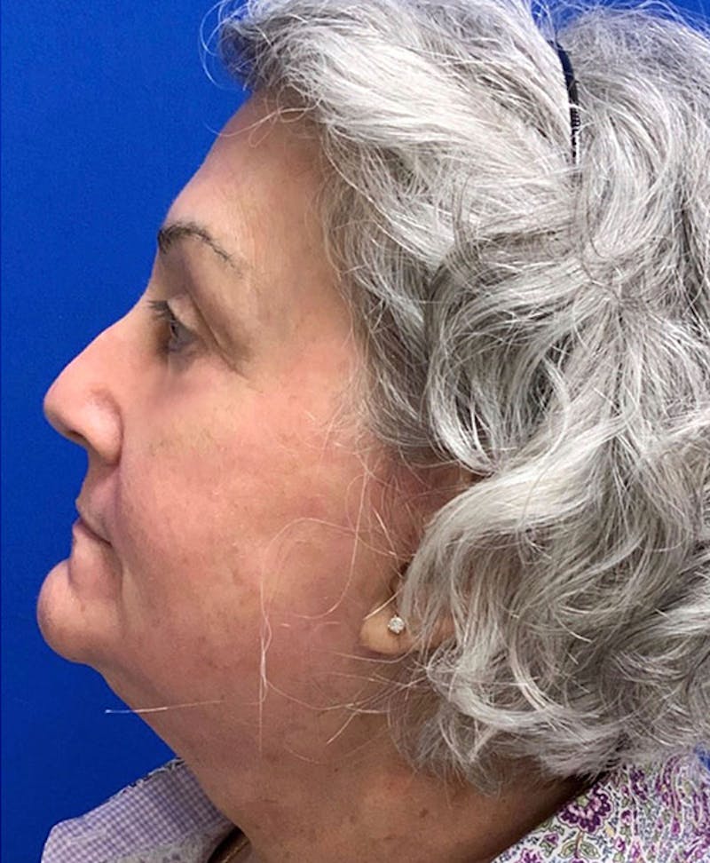 Face Before & After Gallery - Patient 63360275 - Image 6