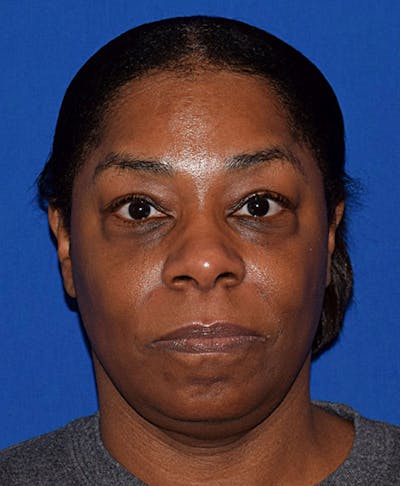 Face Before & After Gallery - Patient 63360280 - Image 1