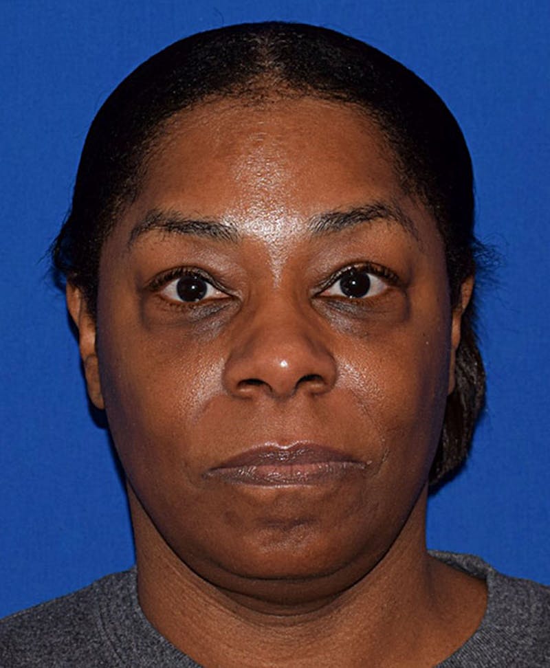 Face Before & After Gallery - Patient 63360280 - Image 1
