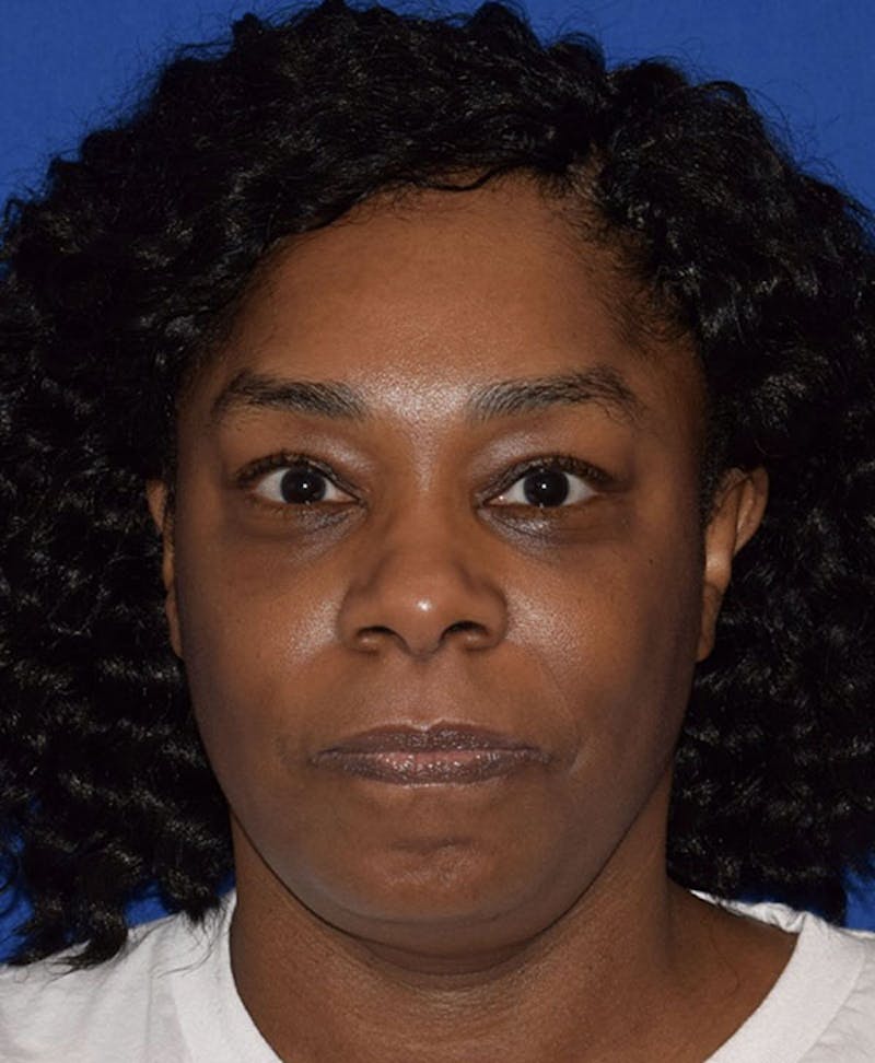 Face Before & After Gallery - Patient 63360280 - Image 2
