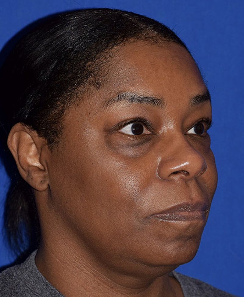 Face Before & After Gallery - Patient 63360280 - Image 3