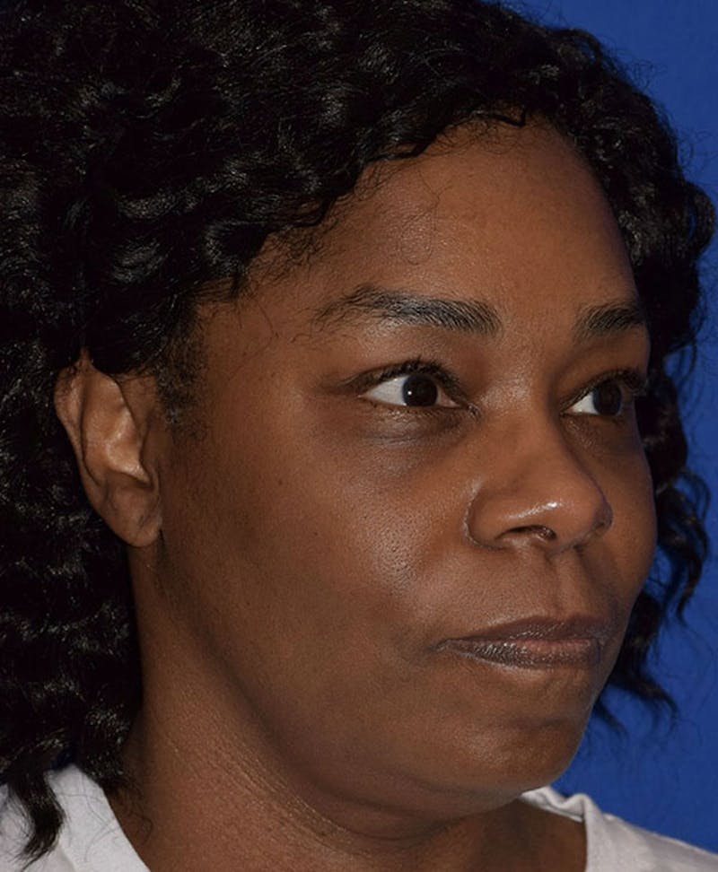 Face Before & After Gallery - Patient 63360280 - Image 4