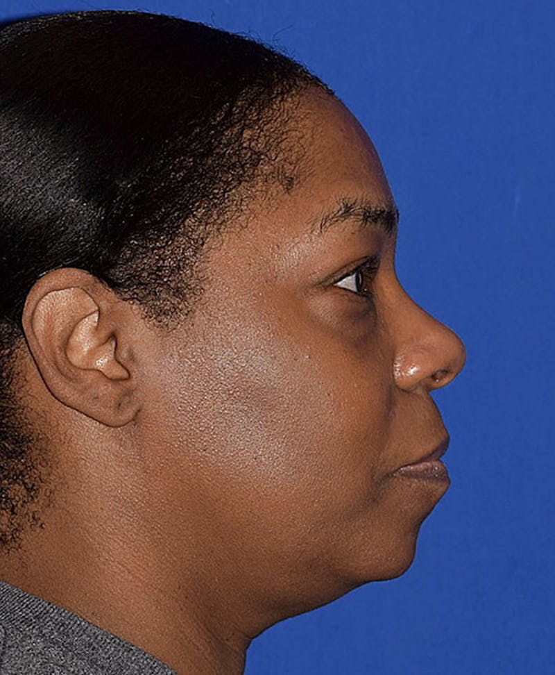 Face Before & After Gallery - Patient 63360280 - Image 5