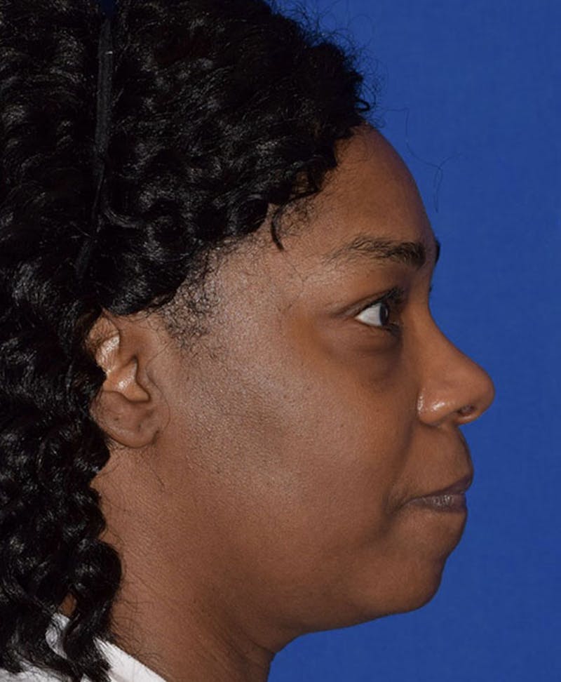 Face Before & After Gallery - Patient 63360280 - Image 6