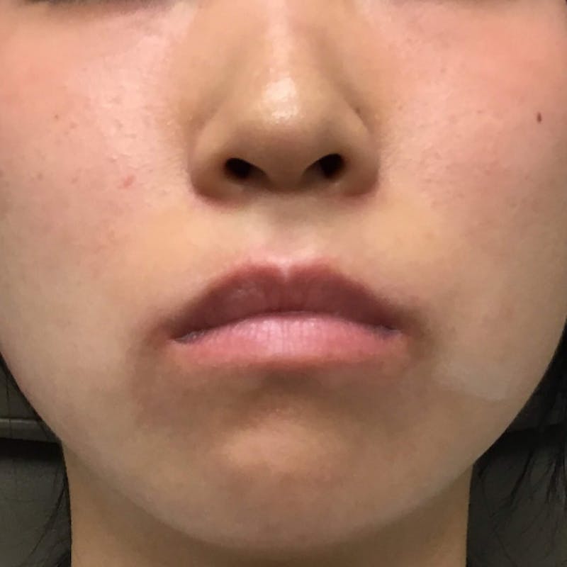 Non-Surgical Before & After Gallery - Patient 63360282 - Image 1