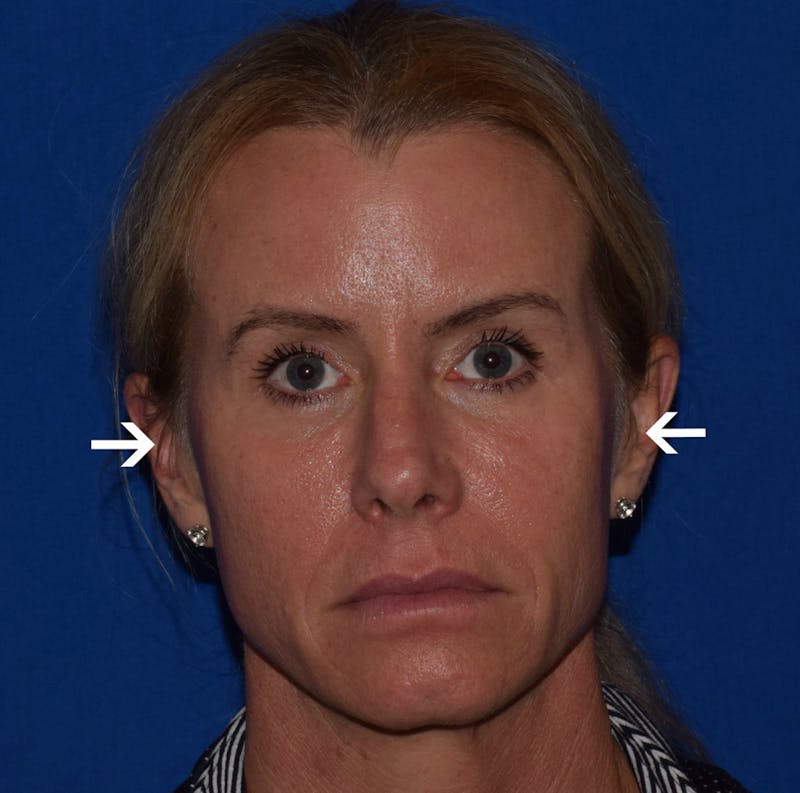 Non-Surgical Before & After Gallery - Patient 63360286 - Image 1