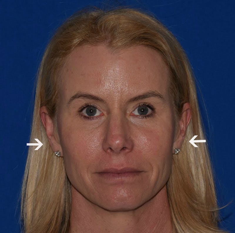 Cosmetic Non-Surgical Before & After Gallery - Patient 63360286 - Image 2