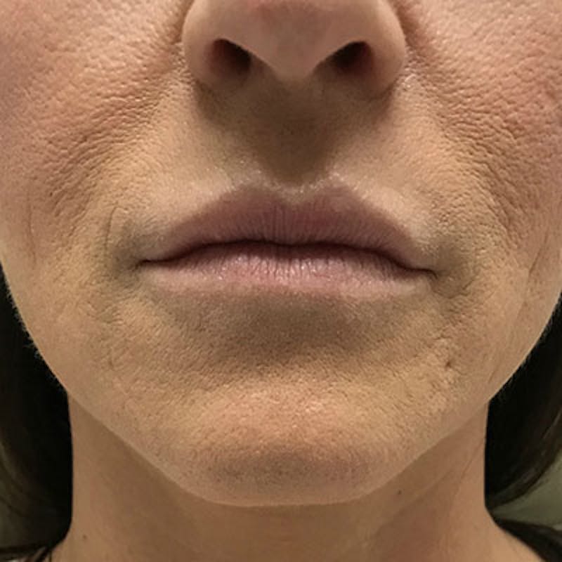 Non-Surgical Before & After Gallery - Patient 63360288 - Image 1