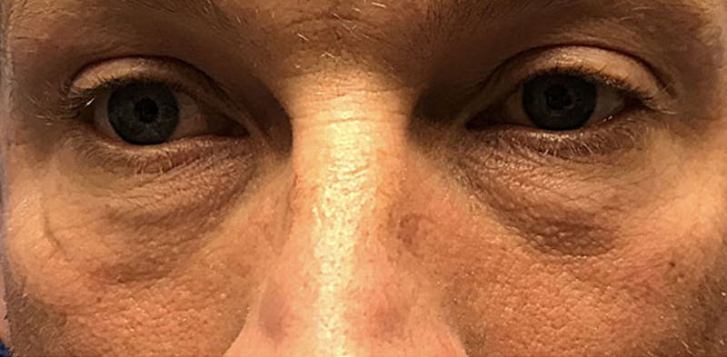 Face Before & After Gallery - Patient 63360412 - Image 1