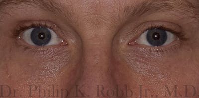 Face Before & After Gallery - Patient 63360412 - Image 2