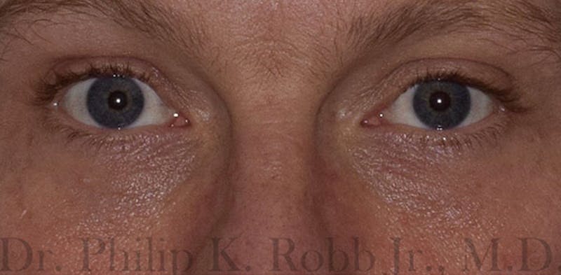 Face Before & After Gallery - Patient 63360412 - Image 2
