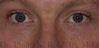 Cosmetic Surgical Before & After Gallery - Patient 63360412 - Image 2