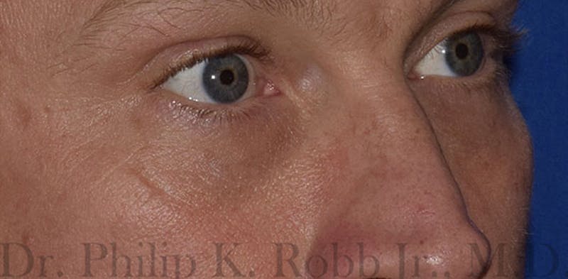 Face Before & After Gallery - Patient 63360412 - Image 4