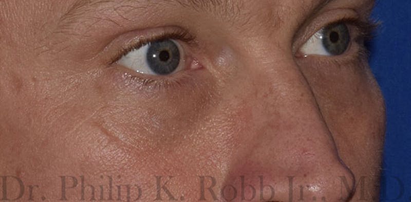 Cosmetic Surgical Before & After Gallery - Patient 63360412 - Image 4