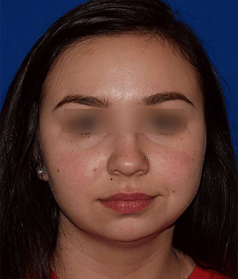 Face Before & After Gallery - Patient 63360414 - Image 1