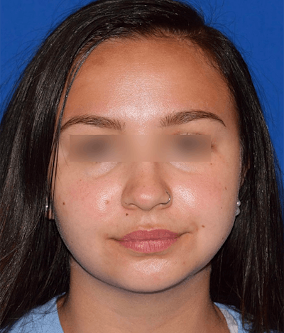 Face Before & After Gallery - Patient 63360414 - Image 2