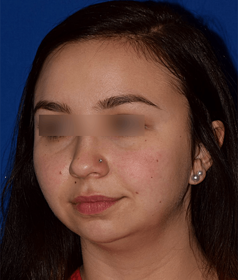 Face Before & After Gallery - Patient 63360414 - Image 3