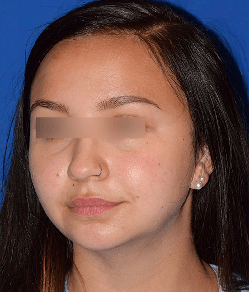 Cosmetic Surgical Before & After Gallery - Patient 63360414 - Image 4