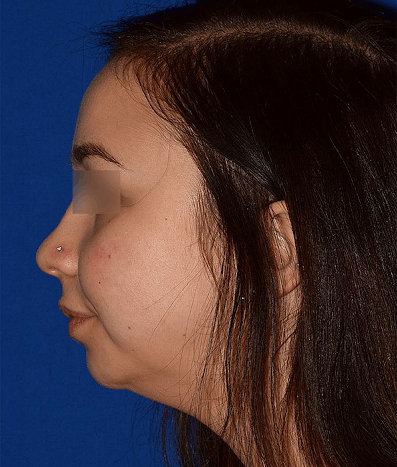 Face Before & After Gallery - Patient 63360414 - Image 5