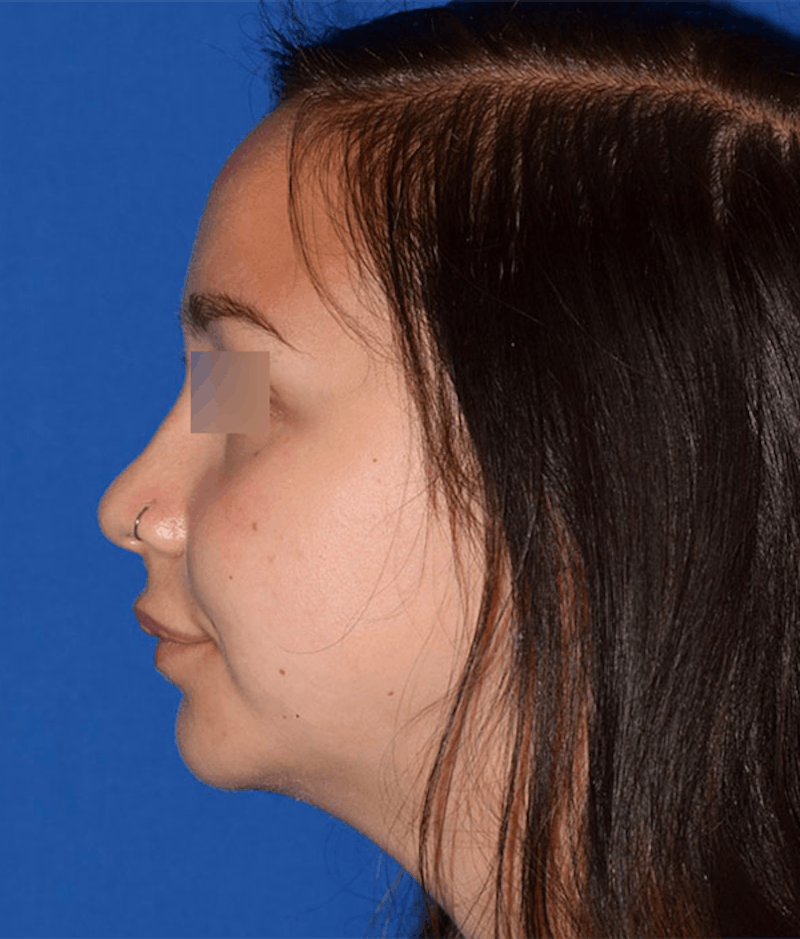 Cosmetic Surgical Before & After Gallery - Patient 63360414 - Image 6