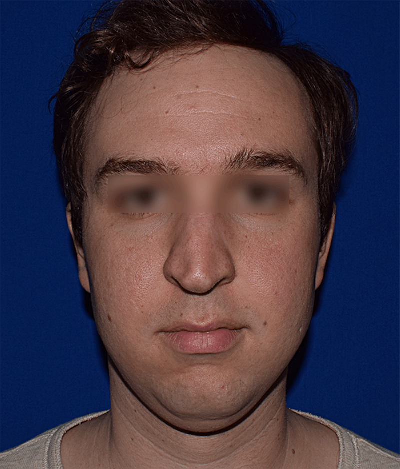 Face Before & After Gallery - Patient 63360415 - Image 1