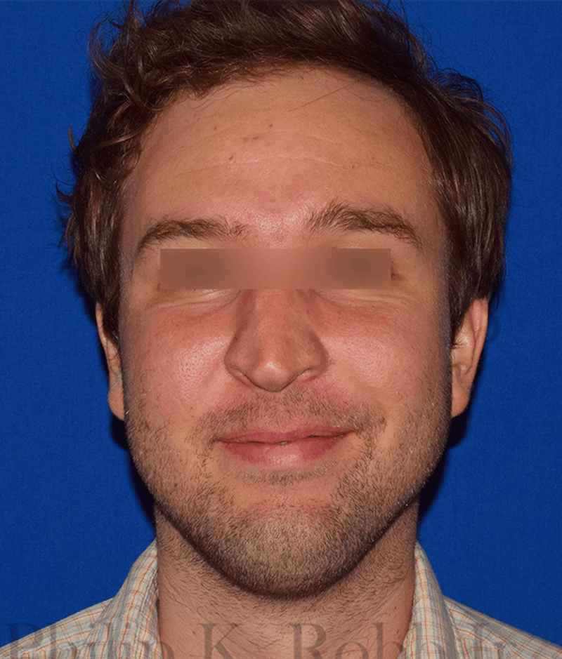 Face Before & After Gallery - Patient 63360415 - Image 2
