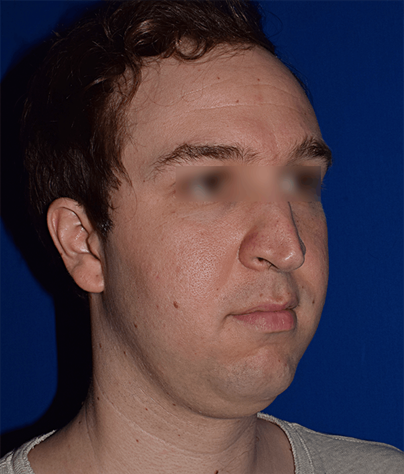 Face Before & After Gallery - Patient 63360415 - Image 3