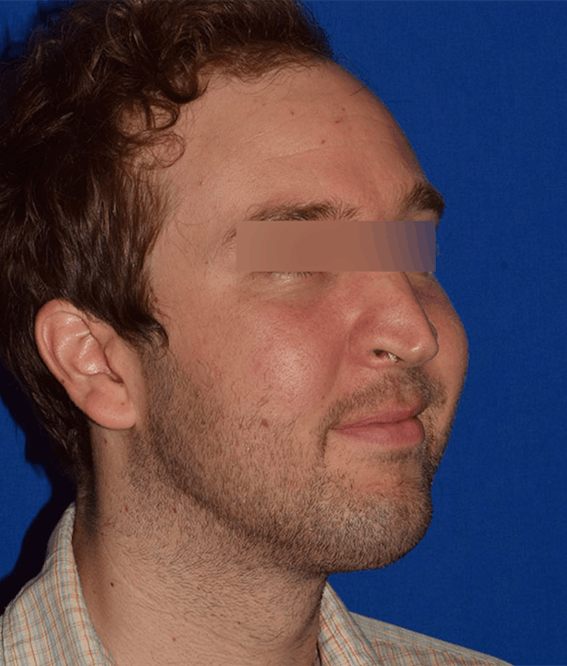 Face Before & After Gallery - Patient 63360415 - Image 4