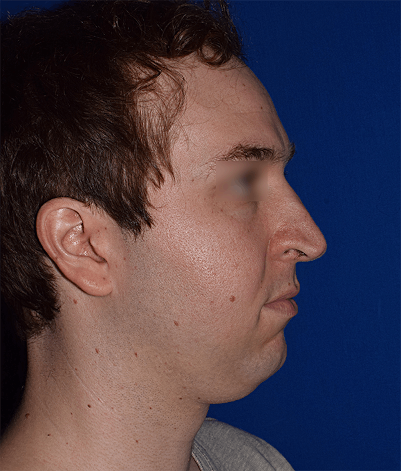 Face Before & After Gallery - Patient 63360415 - Image 5