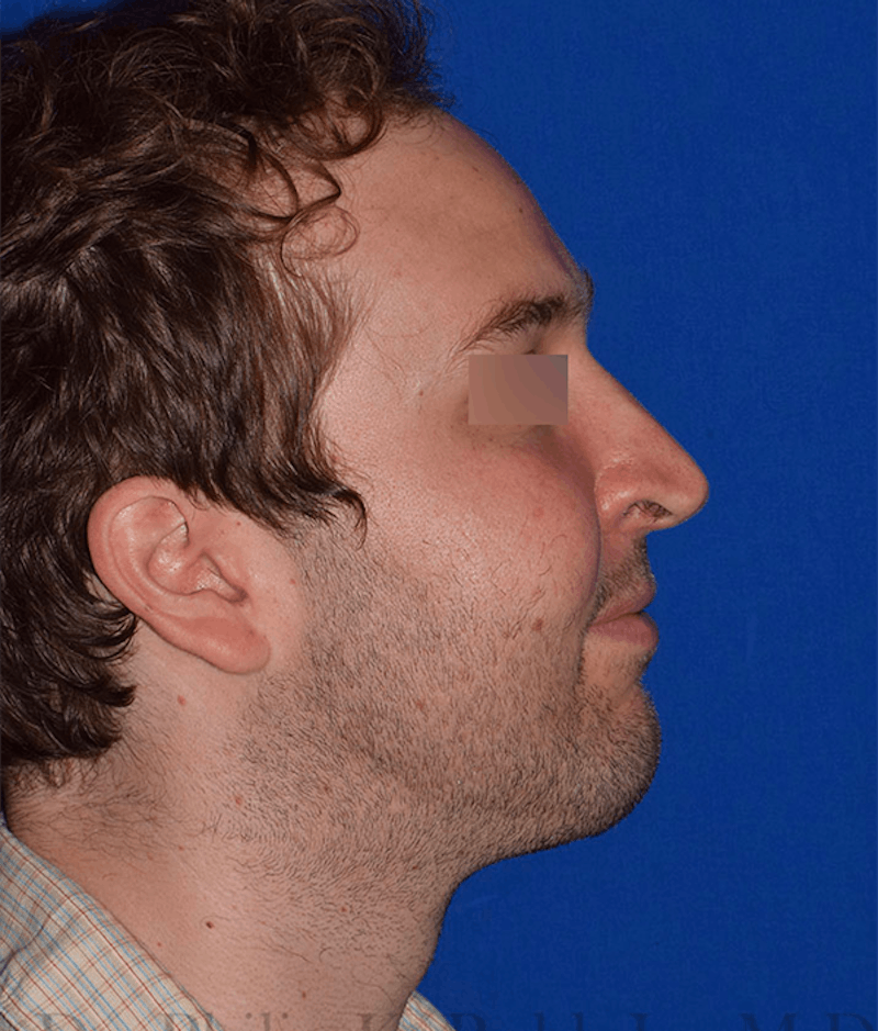 Face Before & After Gallery - Patient 63360415 - Image 6