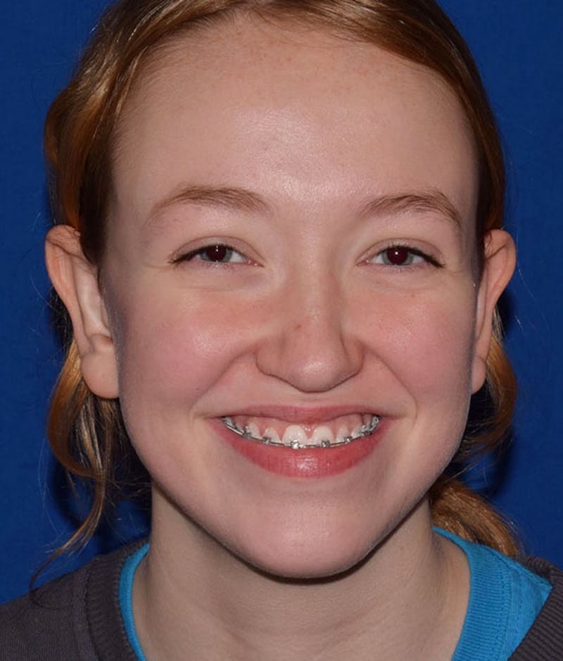 Face Before & After Gallery - Patient 63360417 - Image 2