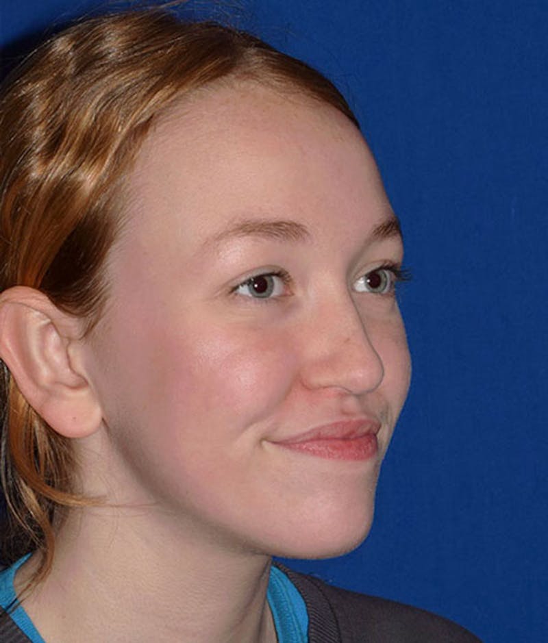 Face Before & After Gallery - Patient 63360417 - Image 4